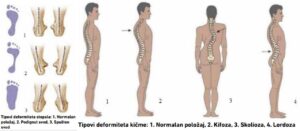 Upozorenje struke: Sve više učenika ima problem sa lokomotornim sistemom