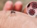 Virus Zapadnog Nila ponovo u fokusu: Kako se zaštititi i kada potražiti pomoć